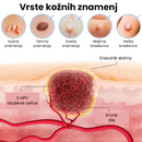 Wart Remover- Cremes para manchas