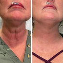 Soro Facial Botulínico