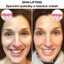 Soro Facial Botulínico